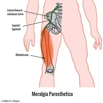 meralgia paresthetica