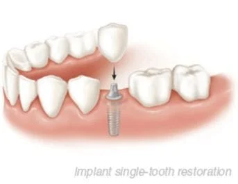 Implant Single-Tooth Restoration