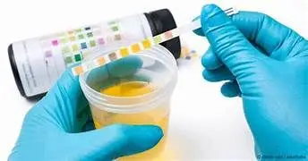 urinalysis