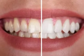 Teeth Whitening | Dentist in Fairfax, VA | Progressive Dental Care