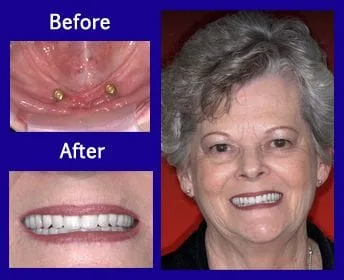 Carolyn's beautiful dentures designed by Dr. Brad Beasley.