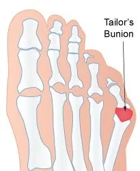 Avenel Podiatrist | Avenel Tailor's Bunion | | Family Podiatry Center |