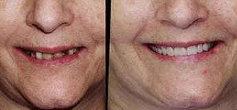 all on 4 dental implats before and after