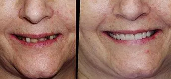 all on 4 dental implants before and after