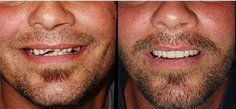 teeth in one day before and after