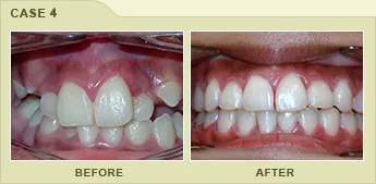 smile - before and after