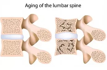 Osteoporosis