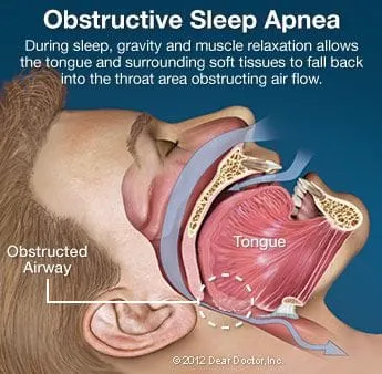Obstructive Sleep Apnea in Manitowoc County