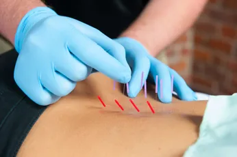 dry needling