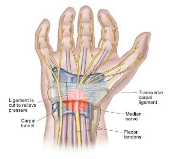 carpal tunnel