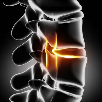 Herniated Disc - Community Chiropractic Center