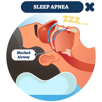 Sleep Apnea