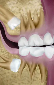 horizontal impaction wisdom tooth Royal Palm Beach, FL