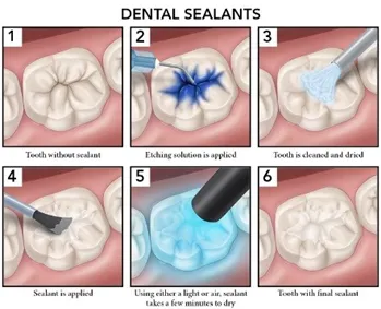 sealants