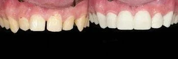 Before & After Cosmetic Dentistry Veneers in Martinsville