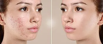 acne treatment before and after