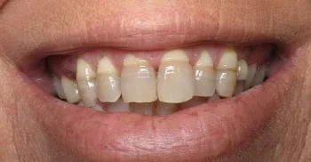 Before Cosmetic Dentistry Treatment, Rockwall Dentist