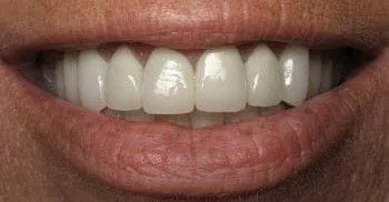 After Cosmetic Dentistry Treatment, Rockwall Dentist