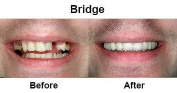 Before and After Bridges