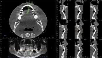 OP 3D Imaging Scan used for precise, and efficient implant placement