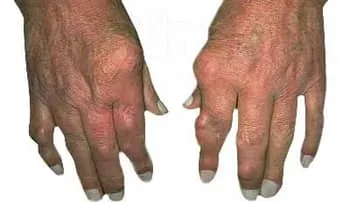 gout in hands