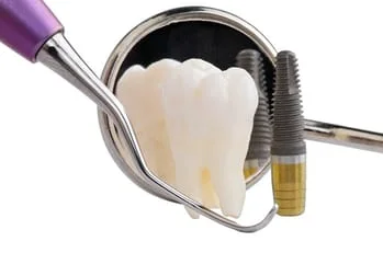 Dental Implants Wilmington, Tooth and Implant