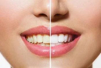 before and after image of woman's teeth, yellowed teeth on left side, whitened teeth on right side, teeth whitening Ottawa, ON cosmetic dentistry