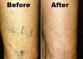 Spider Veins and Sclerotherapy