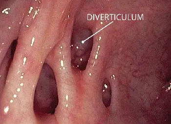 Diverticulosis