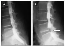 Spinal stenosis Information