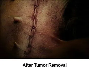 Breast Tumor Surgery aka Mastectomy