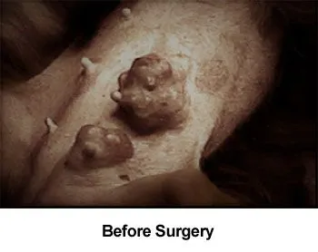 Breast Tumor Surgery aka Mastectomy