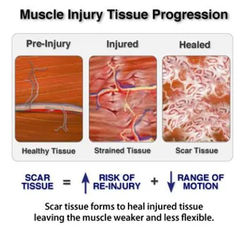 The Graston Technique is Ideal for Breaking Down Scar Tissue to Restore  Range of Motion – Chiropractic BioPhysics