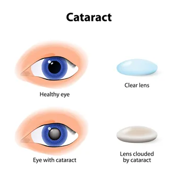 Cataracts