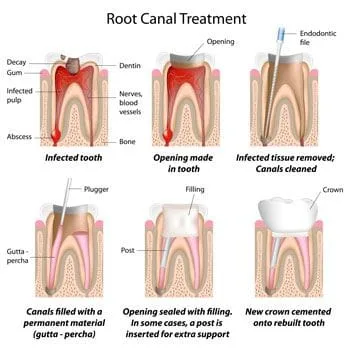 Root Canal Treatment - Dentist in Huntsville, AL