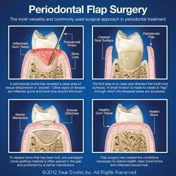 Periodontal flap surgery.