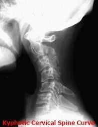 C_spine___kyphotic.jpg