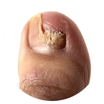 toenail fungus