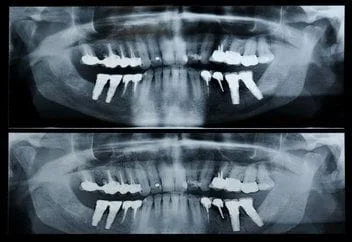 dental x-ray image of teeth, emergency dentist Columbia, MO 