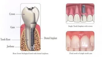 diagram of dental implant assembly and mouth with implant in Issaquah, WA