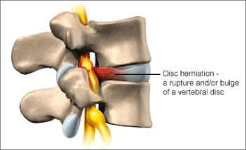 Herniated Disc: Causes, Symptoms, Treatment, and Prevention, ProActive  Physical Therapy Clinics