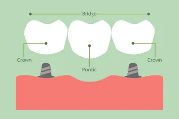 Dental Crowns And Bridges | Dentist in Fairfax, VA | Progressive Dental Care