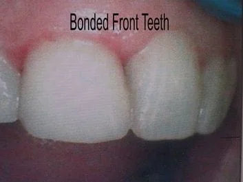 Fractured Teeth