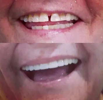 Dental veneers Dental veneers