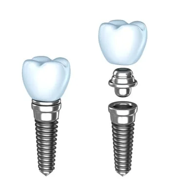 Dental Implants Upland CA