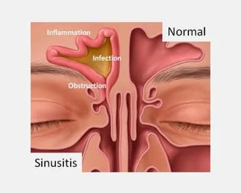 sinus image