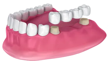 4-unit Bridge | Dentist In Fircrest, WA | Emerson Dental