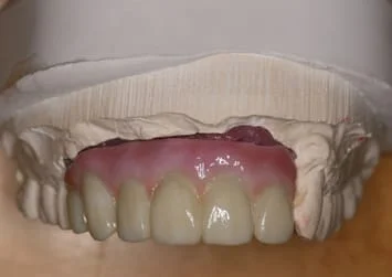Dental prosthetic on model