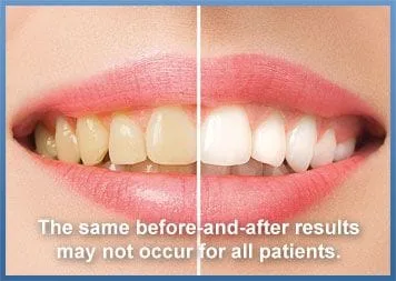 Teeth Whitening Dentist Fullerton CA