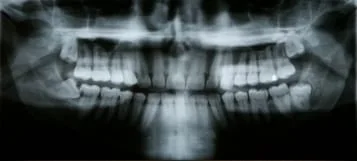 After Impacted Tooth